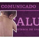 caso de sarampion en el aeropuerto de la ciudad de mexico