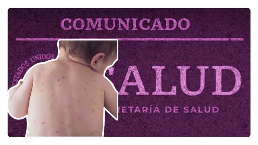 caso de sarampion en el aeropuerto de la ciudad de mexico