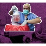 Exitoso el primer trasplante de riñón de un cerdo a una persona viva