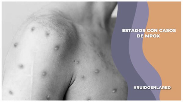 casos de mpox en los estados de méxico