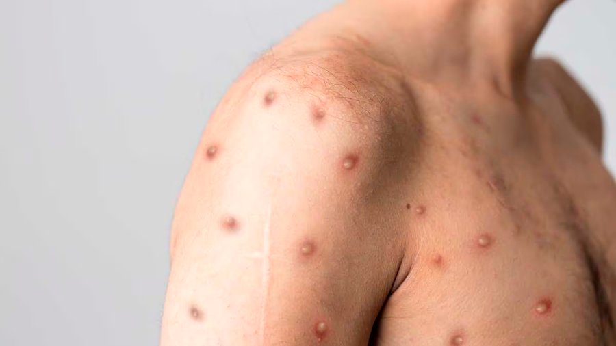 oms anuncia emergencia sanitaria mundial por la variante mpox de la viruela del mono