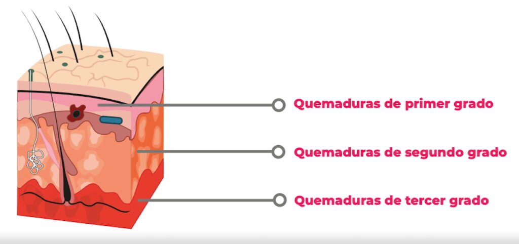 Imagen para nota de qué hacer en caso de quemaduras