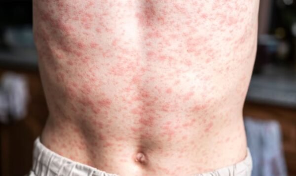 Foto para nota de la ops y el sarampión en México