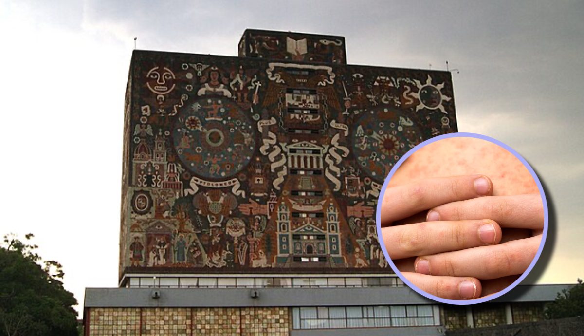 Caso de sarampión en la UNAM