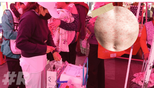 Primera muerte por sarampión en CDMX