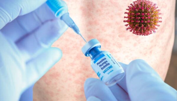 Vacuna contra el sarampión: ¿Quién debe vacunarse? ¿En dónde la aplican?